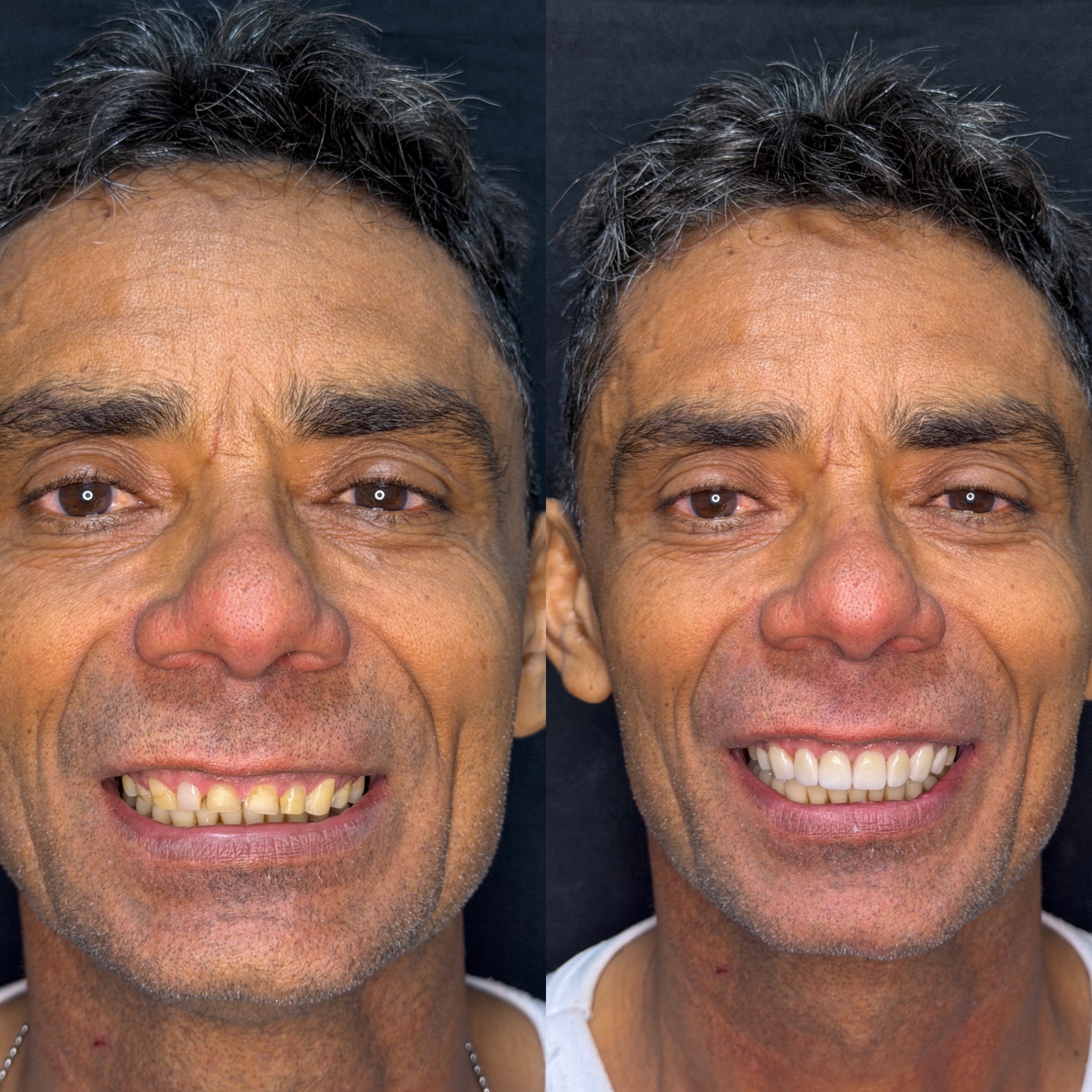 Antes e depois — Facetas em Porcelana Premium