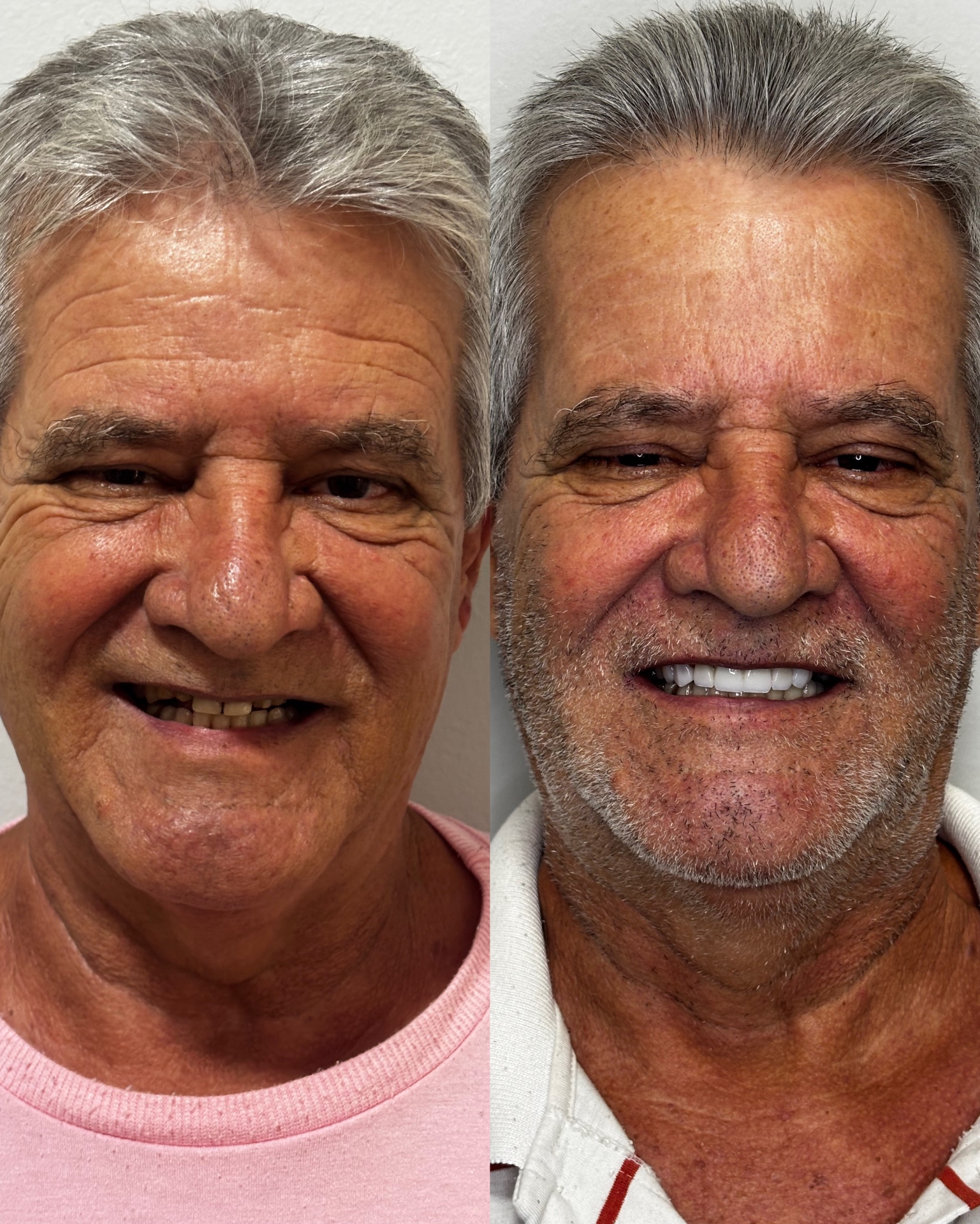 Antes e depois — Reabilitação em Porcelana