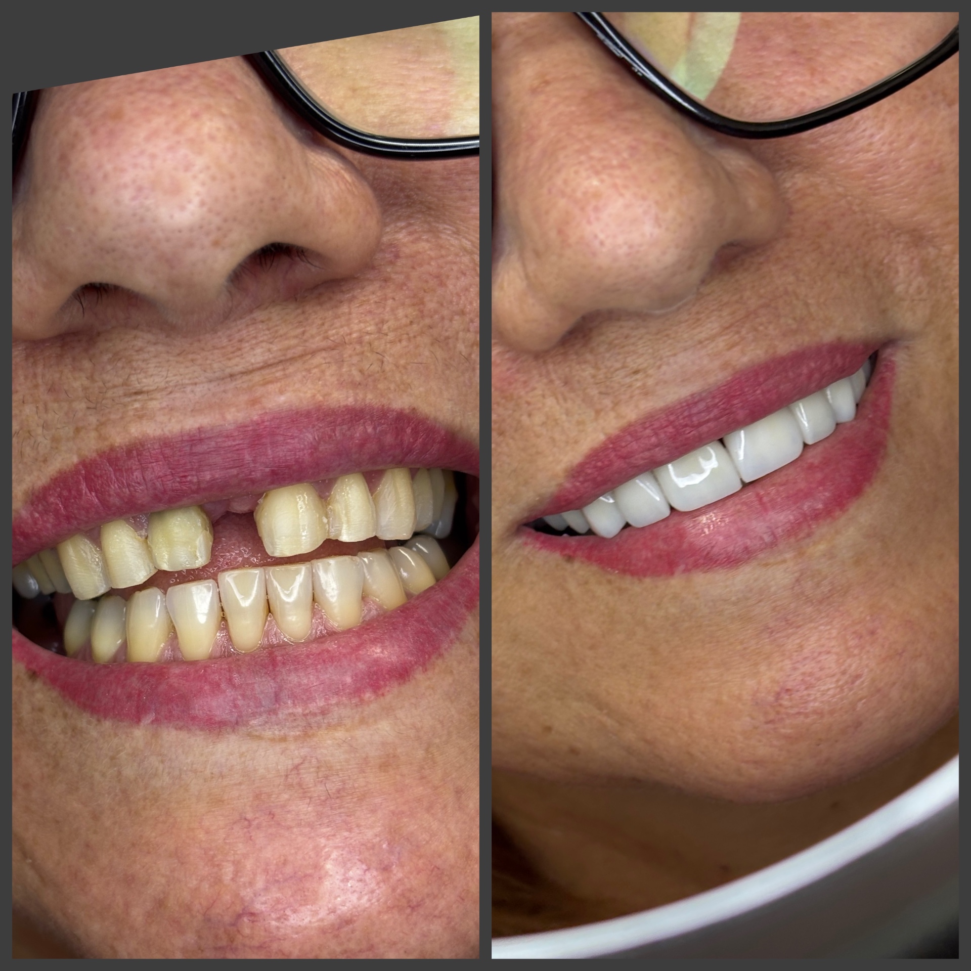 Antes e depois — Lentes em Porcelana Premium
