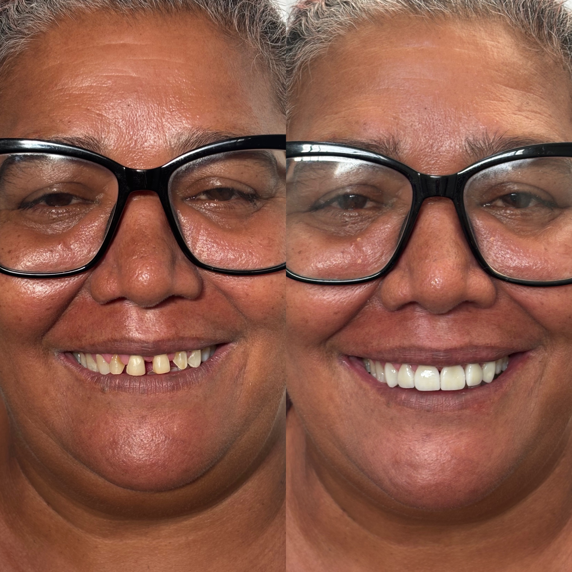 Antes e depois — Reabilitação Estética