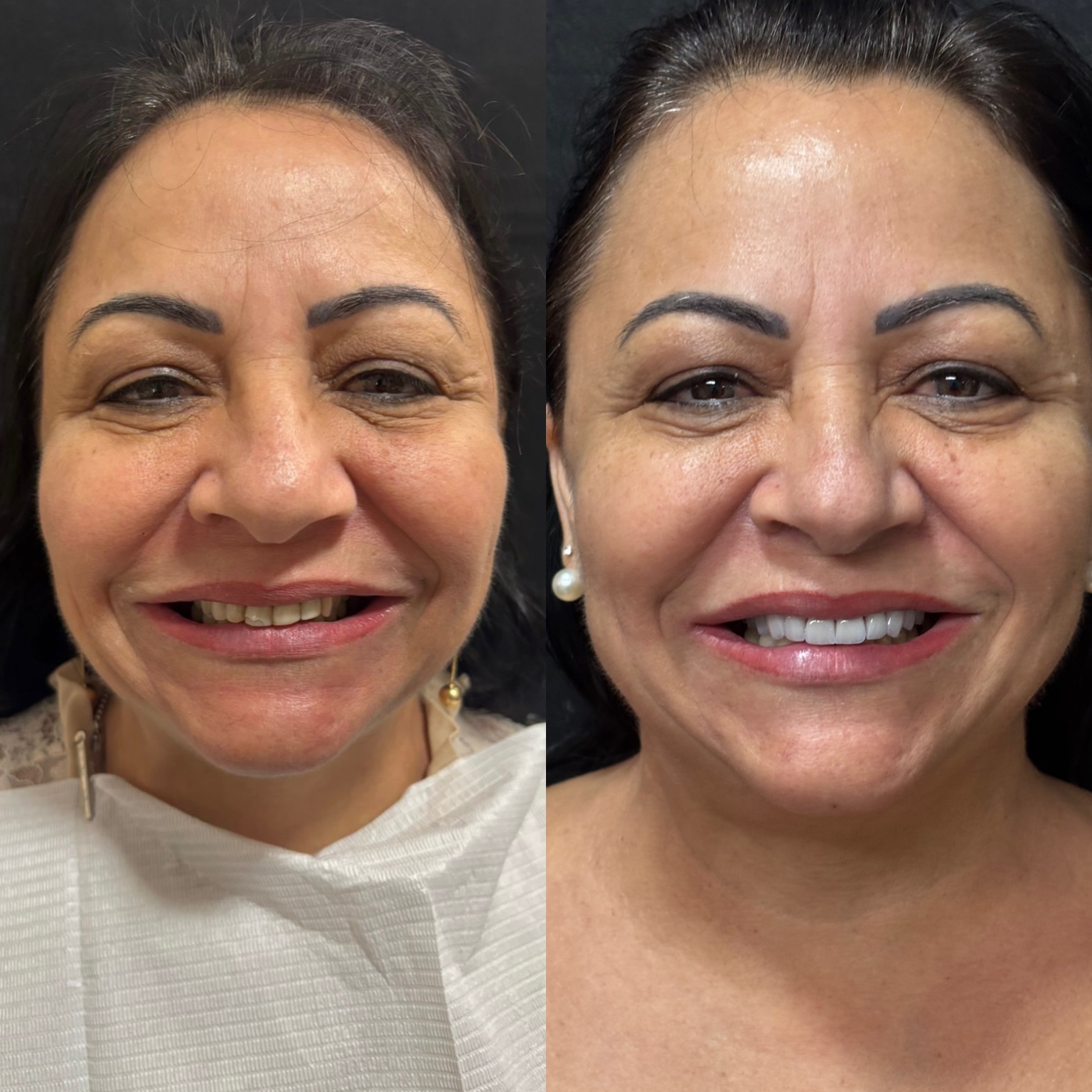 Antes e depois — Facetas em Porcelana