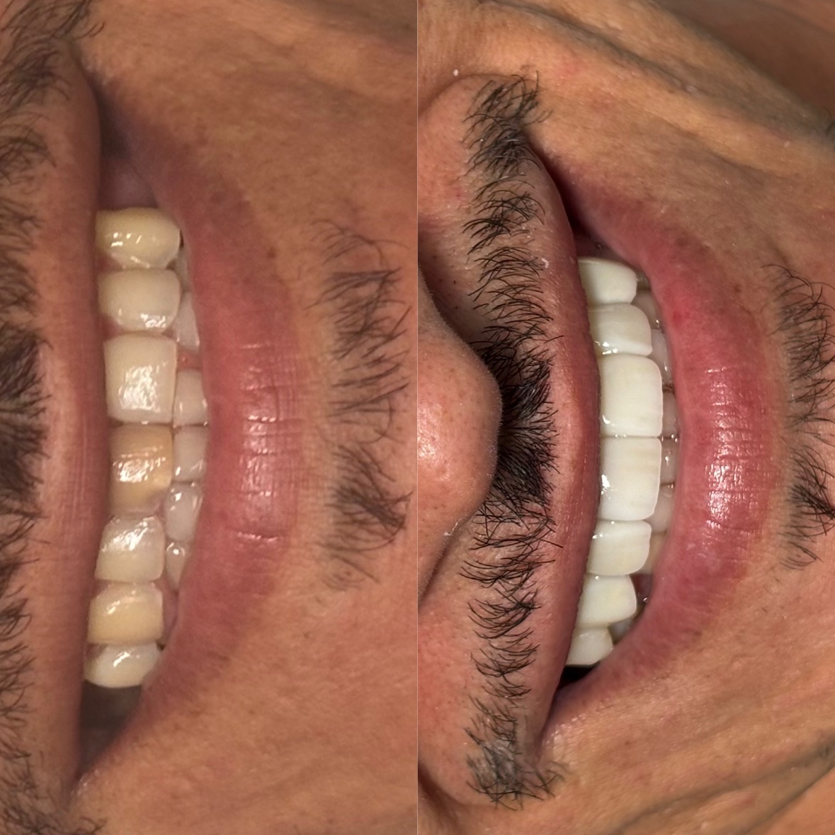 Antes e depois — Porcelana · Vista Lateral