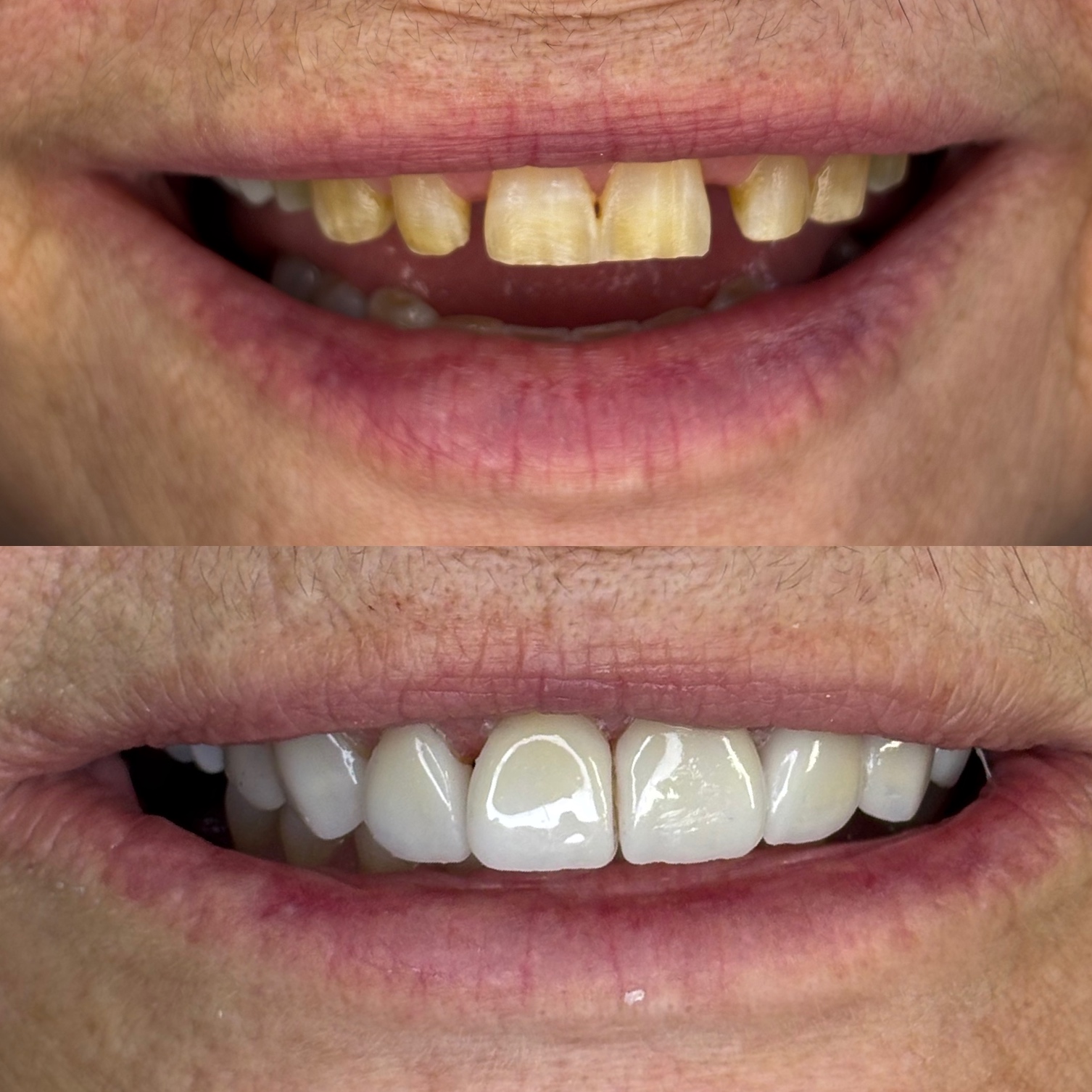 Antes e depois — Facetas em Resina Premium