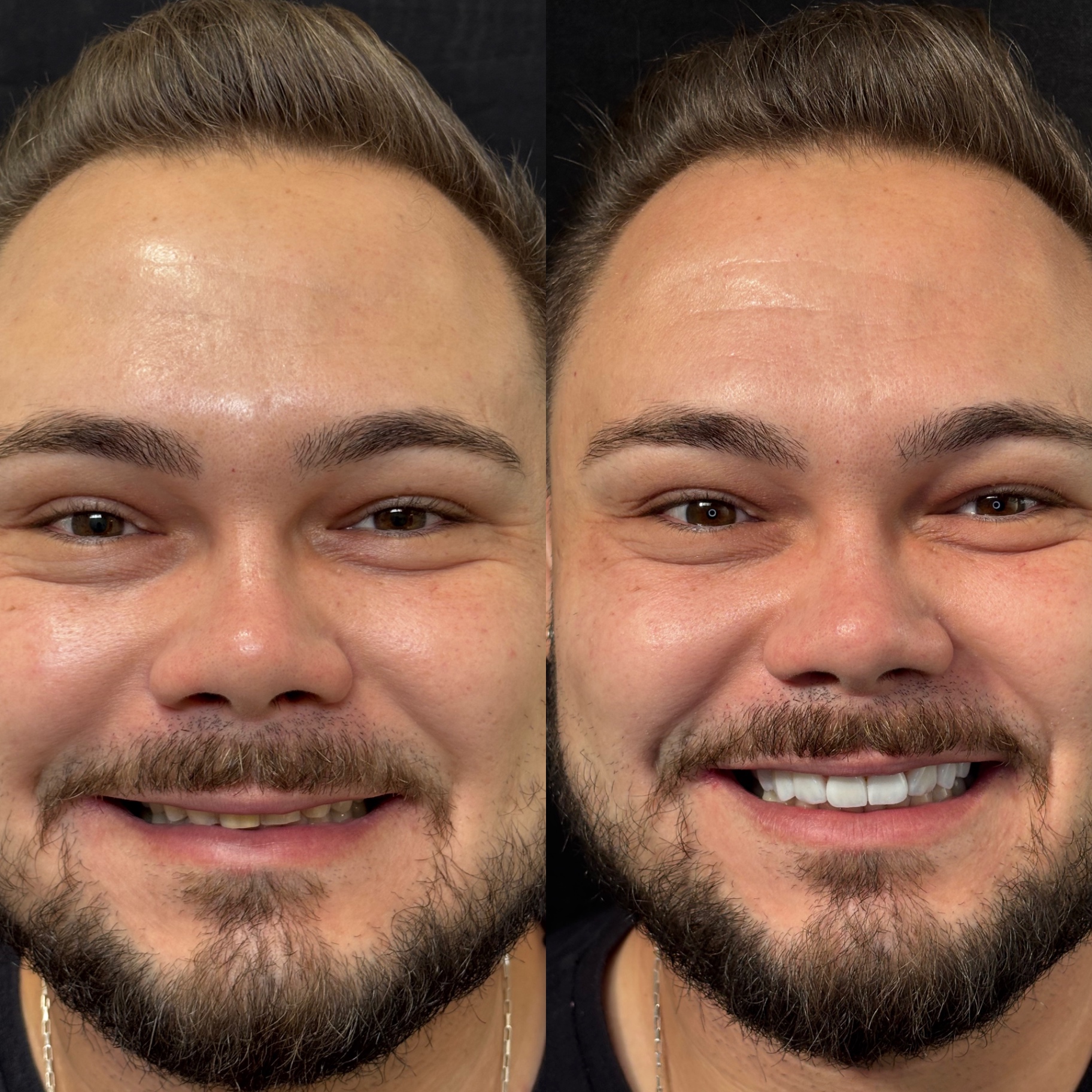Antes e depois — Resina Premium · Sorriso Harmônico