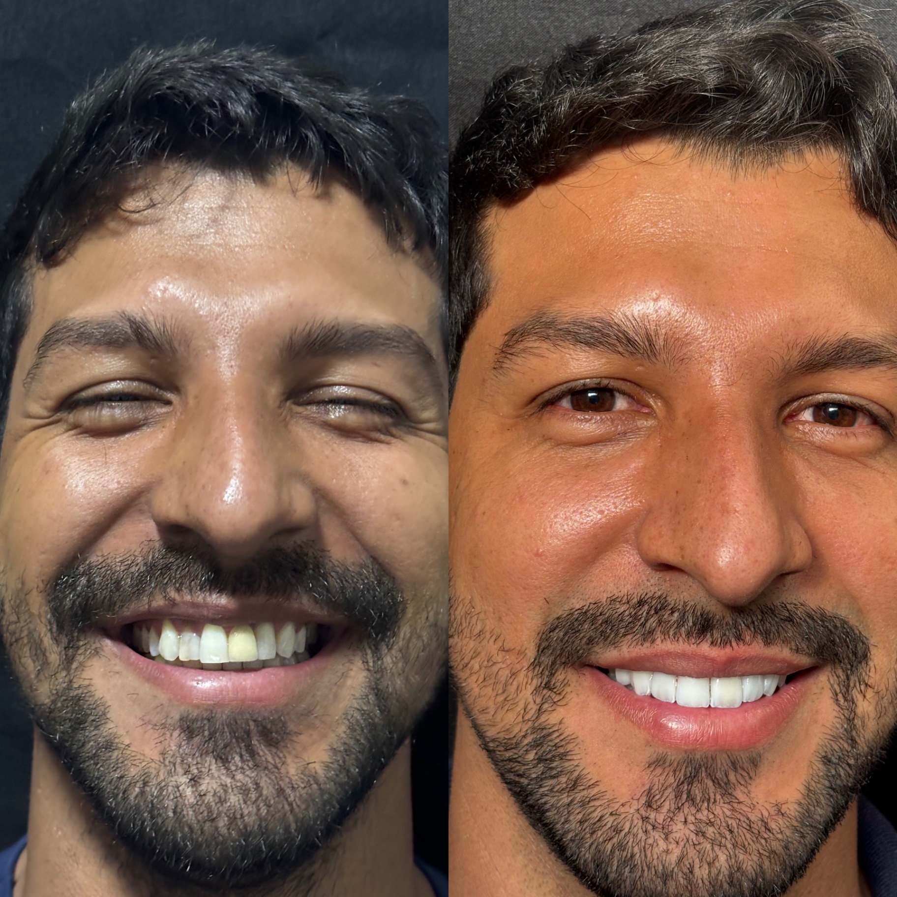 Antes e depois — Lentes em Resina Premium