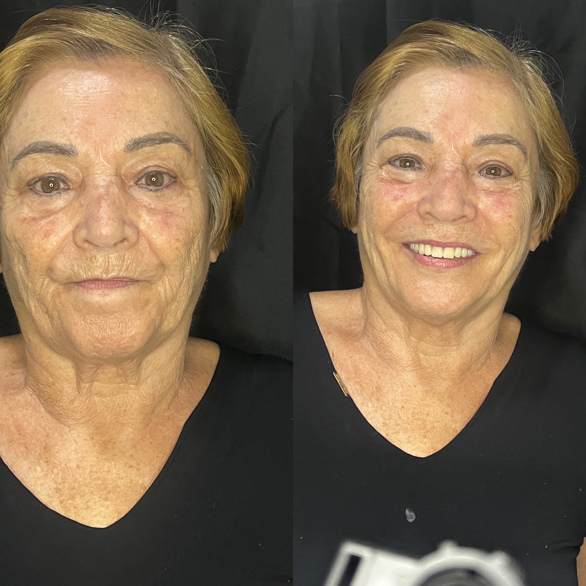 Antes e depois — Reabilitação Oral Completa