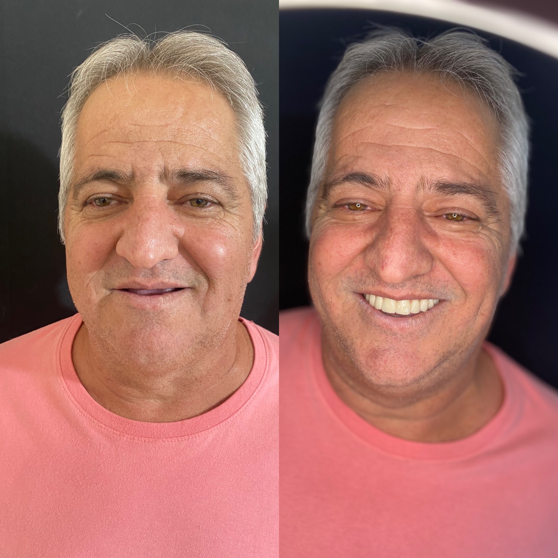 Antes e depois — Prótese Fixa Superior