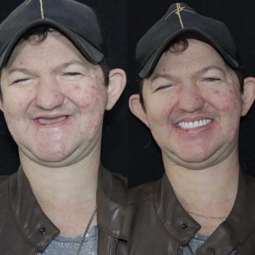 Antes e depois — Reabilitação Completa