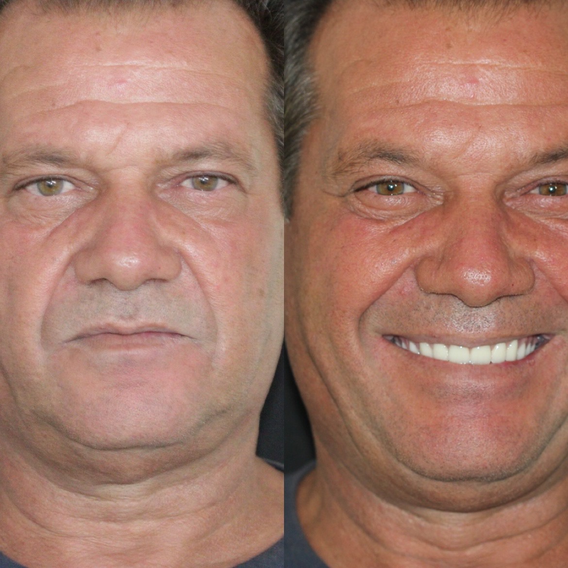 Antes e depois — Protocolo sobre Implante